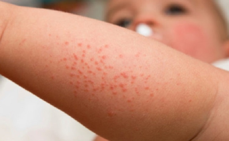 Epidemic situation for measles and anti-epidemic measures in the Kharkiv region